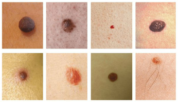 De mest almindelige hud pletter er modermærke og papillomavirus (vorter)