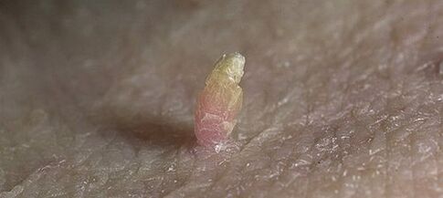 papilloma på penis hvordan man fjerner