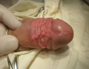 Papilloma på penis