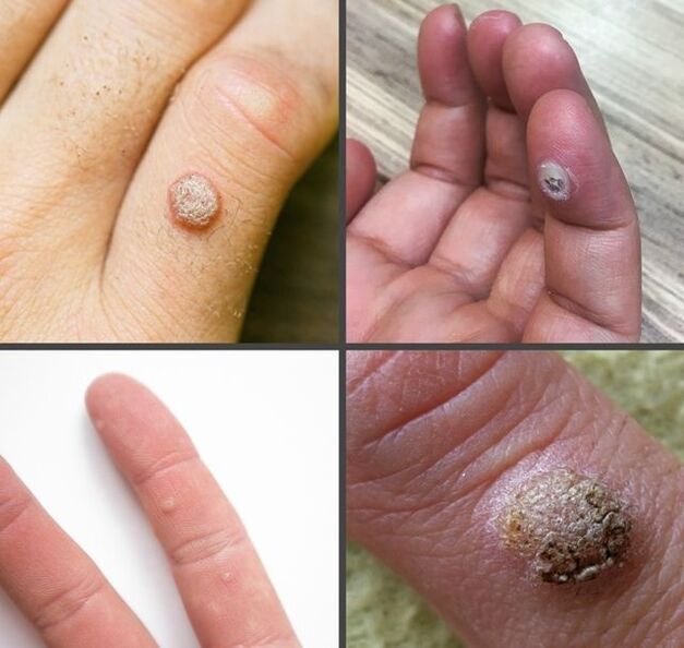 Almindelige typer vorter på fingrene