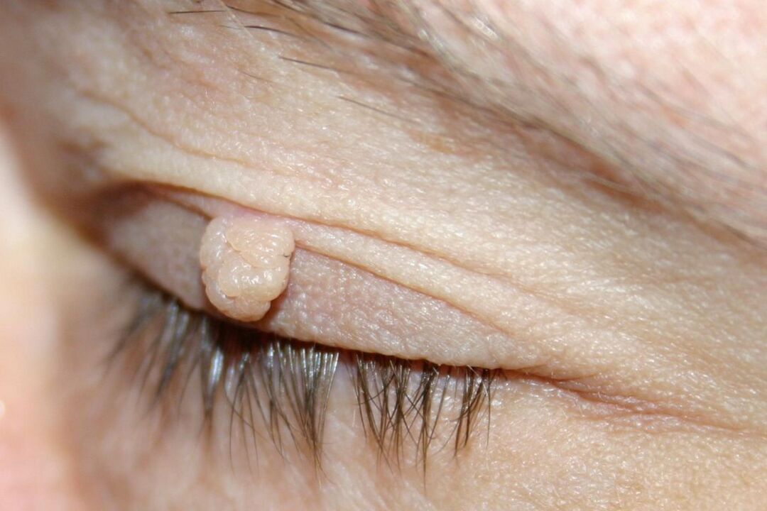 symptomer på papilloma på øjenlåget
