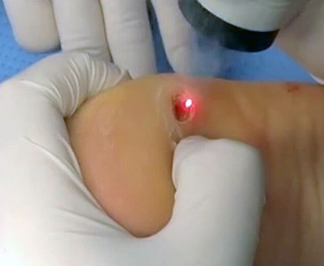 Proceduren til fjernelse af vorter på hælen ved hjælp af en laser