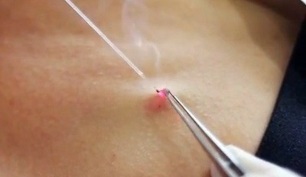 fjernelse af papillomer på kroppen med en laser