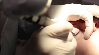 Laserfjerning af papilloma på øjenlåget